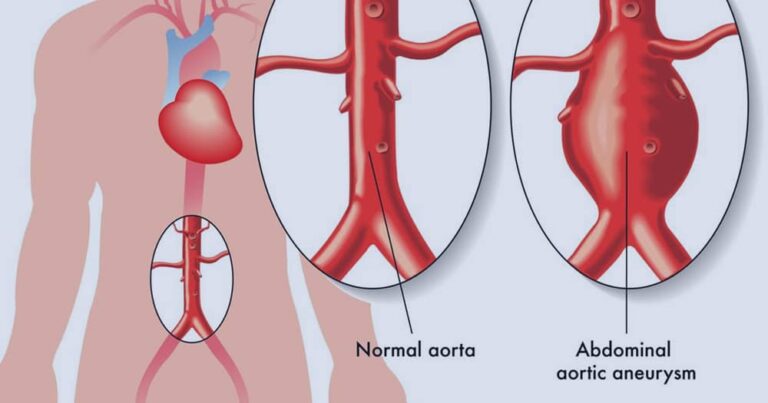 Abdominal aortic aneurysm