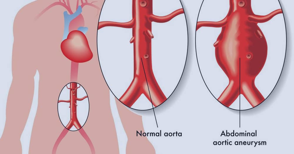Abdominal aortic aneurysm